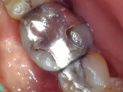 Before replacing amalgam at Unley dentists