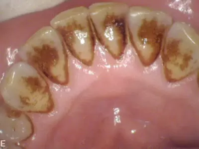 Before dental cleaning by Unley dentists