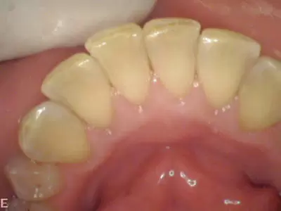 After dental cleaning at Dentistry on Unley