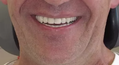 After implant secured denture by Unley dentists