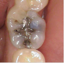 Before replacing amalgam by Unley dentists