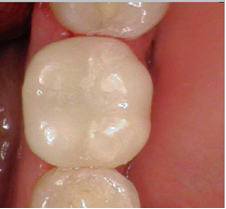 Tooth fillings (after) by Unley dentists