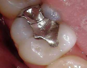 Before replacing almagam and restoring with tooth fillings with Unley dentists