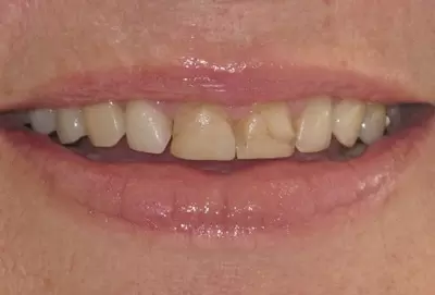 Before dental veneers with Unley dentists