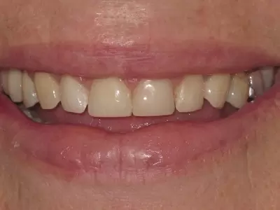After dental veneers with Unley dentists