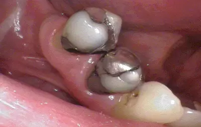 Before replacing almagam and restoring with tooth fillings with Unley dentists