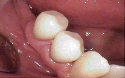 Tooth fillings by Unley dentists