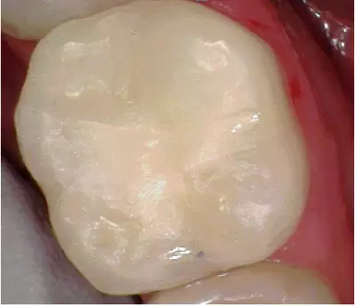 Tooth fillings by Unley dentists