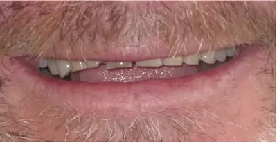 Before dental veneers with Unley dentists