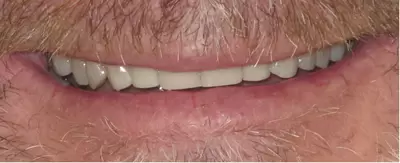 After dental veneers with Unley dentists