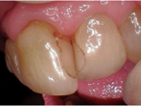 Before treatment with Unley dentists