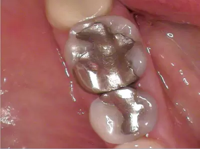 Before replacing almagam and restoring with tooth fillings with Unley dentists