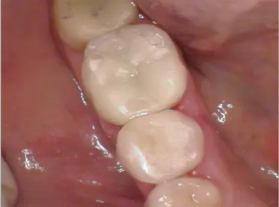 Tooth fillings by Unley dentists