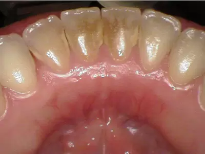 Before dental cleaning by Unley dentists