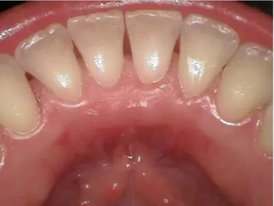 After dental cleaning by Unley dentists