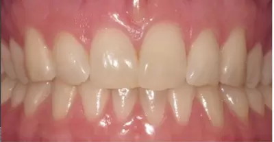 Replacing old dentures with implant secured dentures by Unley dentists