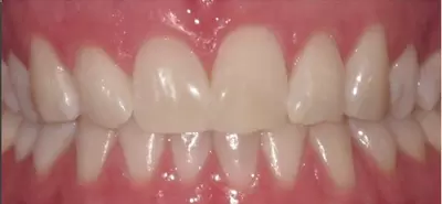 Replacing old dentures with implant secured dentures by Unley dentists