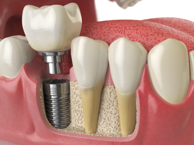dental implant in unley with implant dentist adelaide