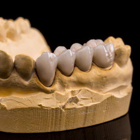 Human jaw made with plaster with ceramic dentures