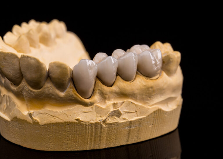 Human jaw made with plaster with ceramic dentures
