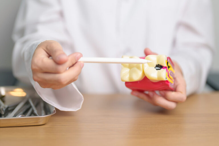 dental decay that requires dental fillling adelaide with unley dentist